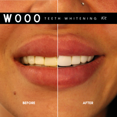 Wooo Teeth Whitening Kit